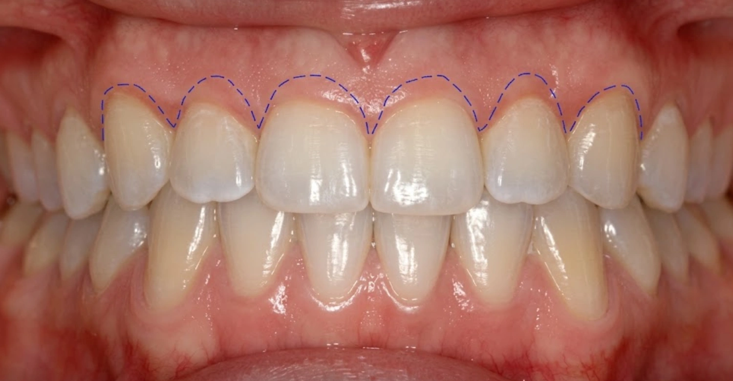 Gum Contouring Recovery Inblog